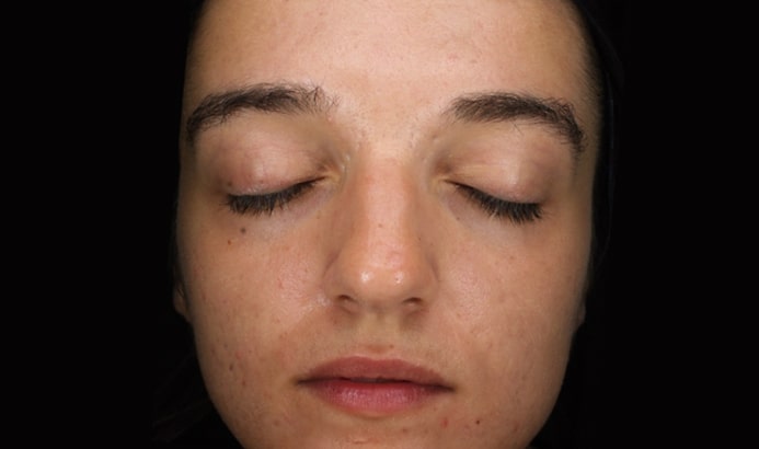 Blemiderm treatment after photo showing clearer facial skin with reduced blemishes