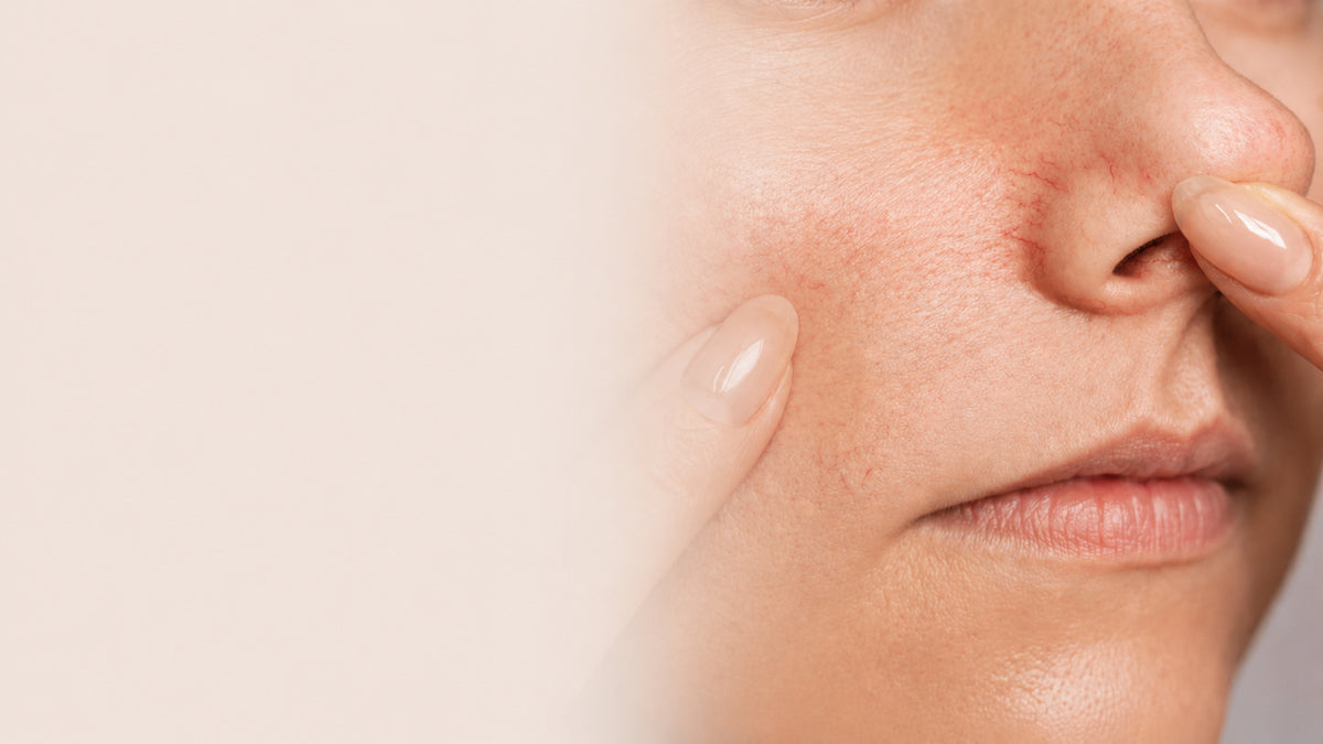 Close-up of a person's face showing red, irritated skin on the cheek and nose, with fingers touching the face against a light beige background.