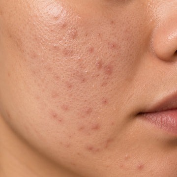Close-up of a person's face with acne on the skin