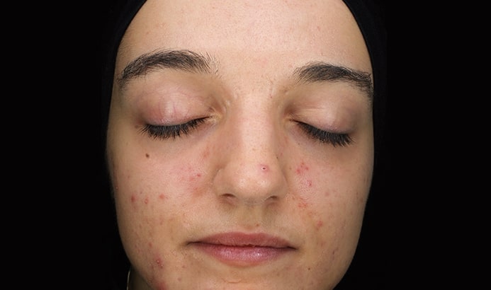 Blemiderm treatment before photo showing facial blemishes, redness and breakouts