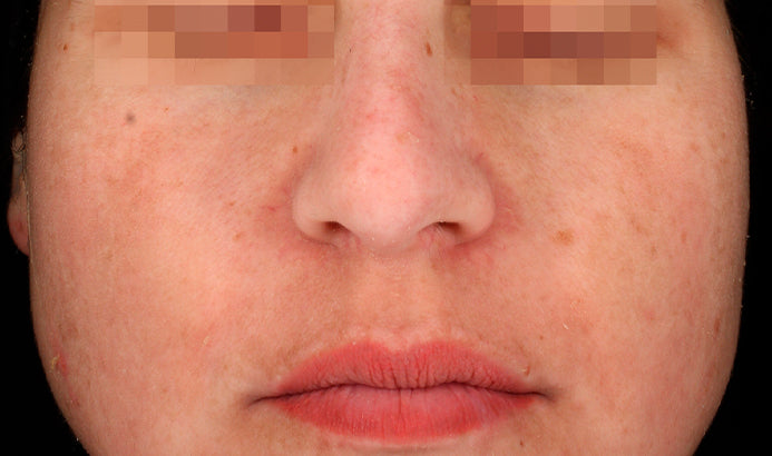 After image showing facial skin following Cosmelan pigmentation treatment