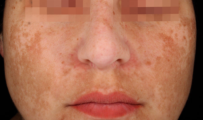 Before image showing facial pigmentation prior to Cosmelan treatment