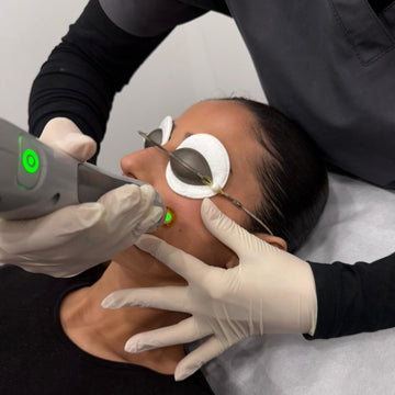 Person receiving a laser Facial Vein  treatment on their face with medical gloves and equipment.