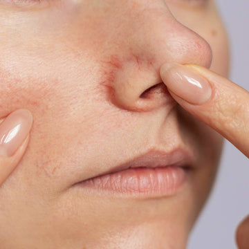 Close-up of a person's nose with a pimple being popped by a finger.