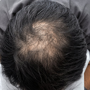 After hair restoration treatment showing improved hair density at the crown