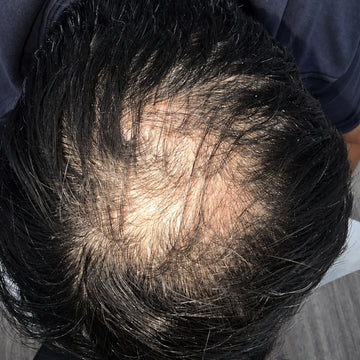 Before hair restoration treatment showing thinning hair at the crown