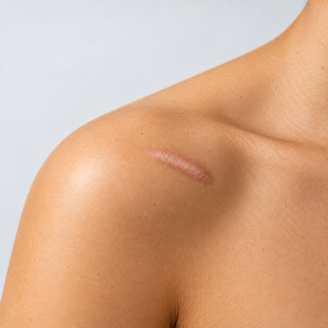 Close-up of a person's shoulder and upper chest showing a raised keloid scar on the deltoid area against a light gray background.