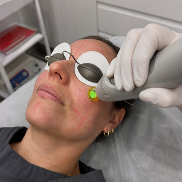 Client receiving laser pigmentation removal treatment on the face at Specialist Skin & Laser Clinics
