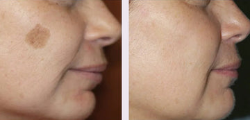 Before and after laser pigmentation removal treatment for a facial sun spot