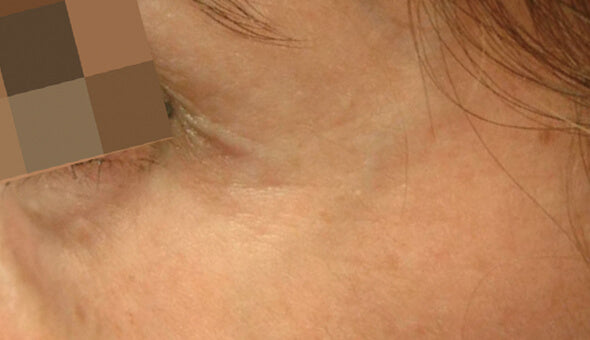After image showing the eye area following Mesoéclat skin treatment