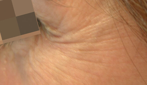Before image showing fine lines around the eye prior to Mesoéclat skin treatment