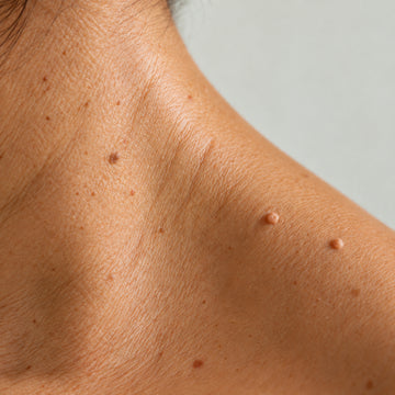 Close-up of a person's neck and upper shoulder showing several small, flesh-toned skin tags or molluscum-like bumps on the skin against a light gray background.