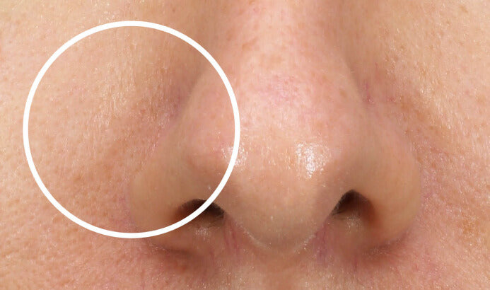 Close-up of smoother-looking skin after Mesoestetic Skinretin treatment