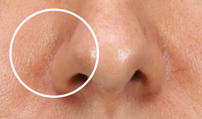 Close-up of skin texture before Mesoestetic Skinretin treatment
